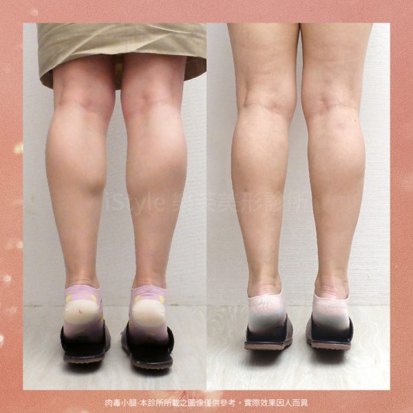 樂芙美形診所-肉毒小腿-botox-legs-calf muscles-istyle-15